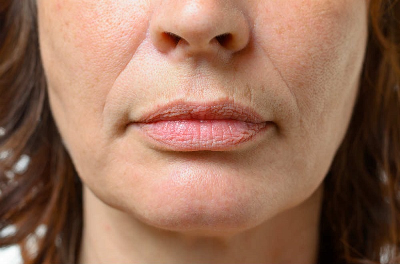 Есть два участка женского лица с наиболее уязвимой кожей: вокруг глаз и над верхней губой. Не так давно мы уже рассказывали вам, как бороться с первой проблемой, а как насчет второй? Вертикальные морщины над верхней губой называют кисетными. Они появляются из-за слабой подкожно-жировой клетчатки и минимального количества сальных желез. При произношении звуков круговая мышца рта активно сокращается, кожа растягивается, кровоснабжение ухудшается, ткани теряют коллаген. Уже в 40 лет это реальная проблема. Нет, не проблема, а настоящий враг красоты. Но, говорят, если знаете врага в лицо, справиться с ним в разы проще. Мы готовы вам в этом помочь. Для начала нужно заняться профилактикой: чтобы уже существующая проблема не усугубилась, пейте много воды, спите не менее 7 часов и пользуйтесь только качественной косметикой. А теперь давайте посмотрим, как убрать те морщины, которые уже успели стать настоящими бороздами. Маски-помощницы Натрите огурец на очень мелкой терке. Смешайте с 1 ч. л. жирной сметаны и 0,5 ч. л. жидкого мёда. Нанесите на зону над верхней губой на 20 минут, а затем умойтесь без мыла. Соедините половинку банана со столовой ложкой сметаны. Нанесите маску на четверть часа, а затем просто смойте. Разомните вилкой 2 ч. л. консервированного горошка. Смешайте с 1 ст. л. кефира. У вас должна получиться достаточно густая масса, которую необходимо равномерно распределить по проблемной зоне на 15 минут. Приложите немного квашеной капусты на 10 минут. Это самая простая маска, но нереально эффективная. В соотношении 1 : 1 смешайте сок алоэ и жидкий мёд. Нанесите на 15 минут, смойте прохладной водой. А еще можно приготовить косметический лёд, который ускорит приток крови и сможет принести даже двойную пользу! Просто пропустите 0,5 кг одуванчиков через соковыжималку, добавьте в жидкость 1 ст. л. оливкового масла, разложите по формам и используйте утром и вечером. Как еще бороться с ними Старайтесь контролировать свою мимику. Те, кто сжимают губы слишком плотно, обзаводятся вертикальными складками быстрее остальных. Не забывайте делать массаж. Это могут быть обычные круговые похлопывания по проблемной зоне самыми кончиками пальцев. Продолжительность — 10 минут. Для умывания используйте только холодную воду или травяные отвары, дабы оказать на кожу освежающее воздействие. Откажитесь от курения. Подобная вредная привычка всегда приводит к преждевременному старению кожи. Контурная пластика, инъекции, биоревитализация — это лишь некоторые из возможных профессиональных подходов к устранению проблемы. Вы, конечно же, может прибегнуть к ним или последовать нашим советам и убрать кисетные морщины без риска и вреда для здоровья. Займитесь профилактикой, устраняйте уже появившиеся морщины, делитесь полезной информацией, наслаждайтесь своей красотой.