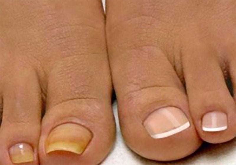 Микоз ногтей: Симптомы, Лечение, Профилактика