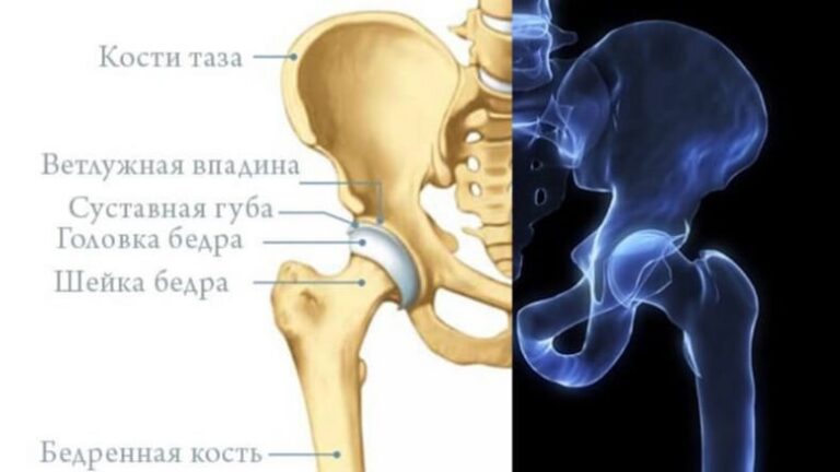 Боли в костях тазобедренного сустава. Строение тазобедренного сустава. Строение тазобедренного сустава у женщин. Скелет тазобедренного сустава. Ревматоидный артрит тазобедренного сустава.